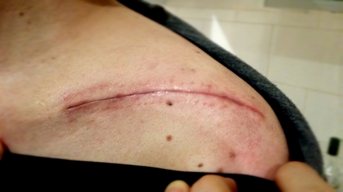 Staples out. Scar at four weeks post-op.